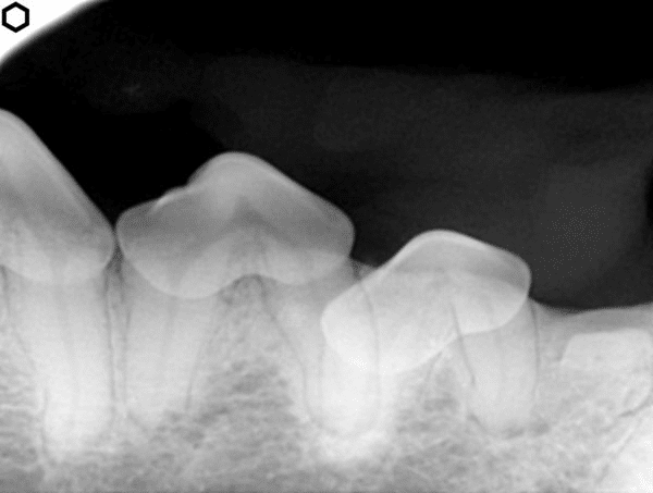 X-ray image of human teeth showing a misaligned tooth and surrounding bone.