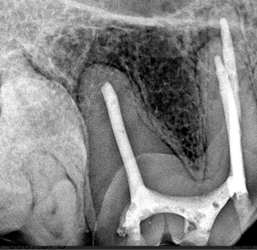 Dental X-ray showing a tooth with three guttapercha fillings in the root canals, surrounded by jawbone.