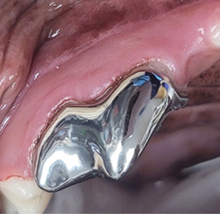 Close-up of a dental metal crown in a mouth, surrounded by pink gum tissue.