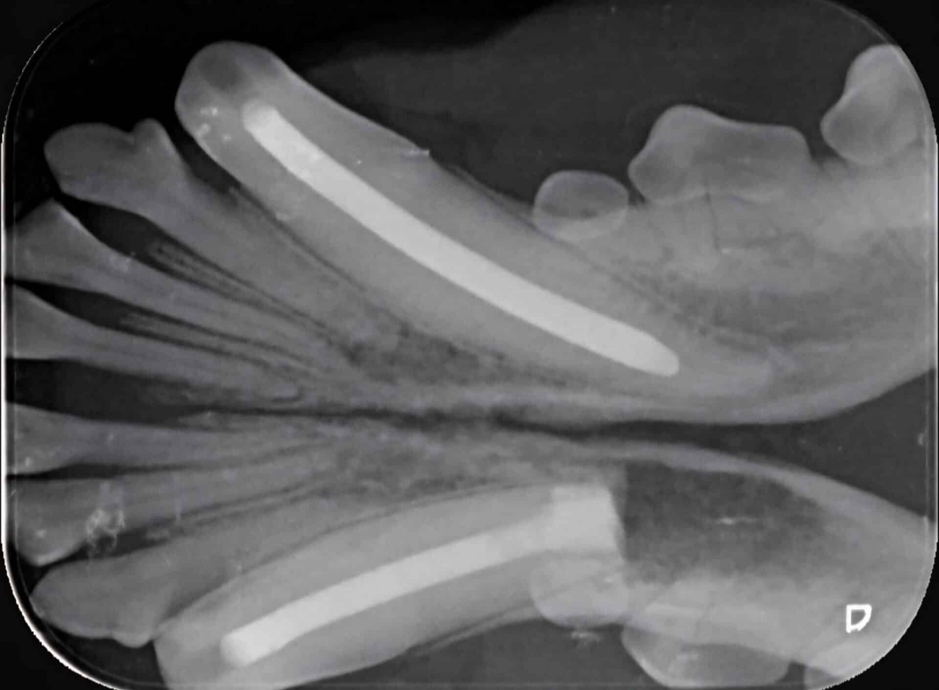 X-ray image showing a lateral view of a hand with two elongated foreign objects inside the soft tissues of the palm and fingers.