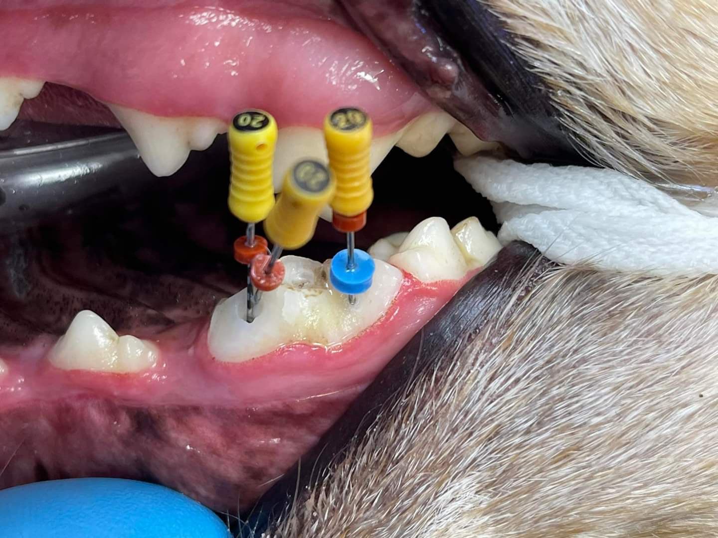 A close-up of a dental procedure in progress, showing dental files inserted into a tooth with exposed gums.