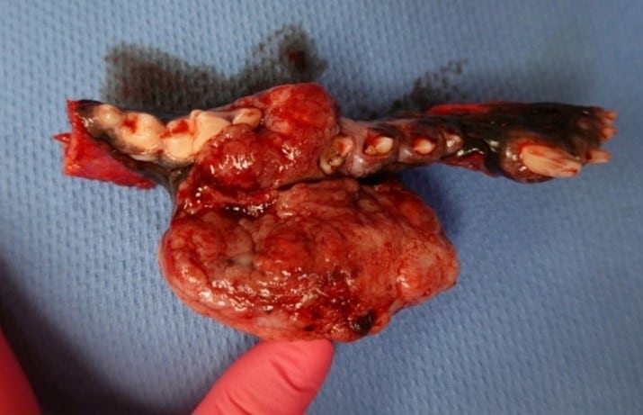 Close-up of a removed human jawbone with attached teeth and surrounding tissue, placed on a blue surgical cloth.