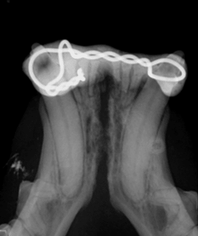 X-ray image of a bilateral mandibular fracture with wire fixation across the jawbones.