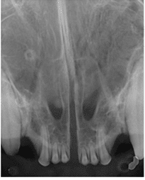 X-ray image showing the front view of the nasal cavities and adjacent structures.