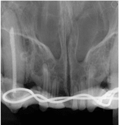 X-ray image showing a dental arch bar and wiring across the lower jaw.