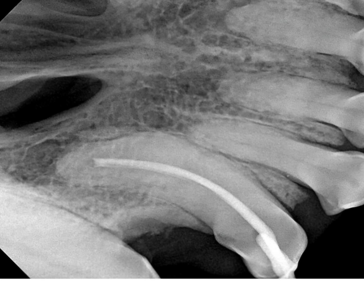 X-ray of teeth showing a dental root canal procedure with a visible file inside one of the tooth canals.