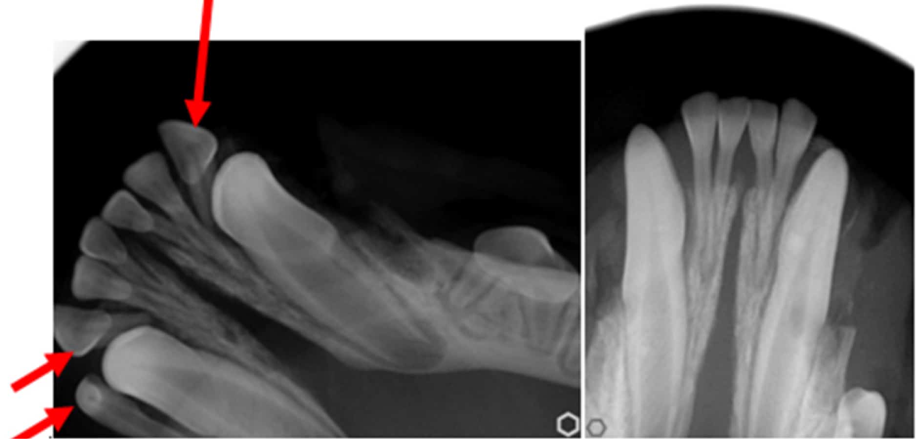 X-ray images showing hand bones with extra digits. Red arrows point to the additional fingers.