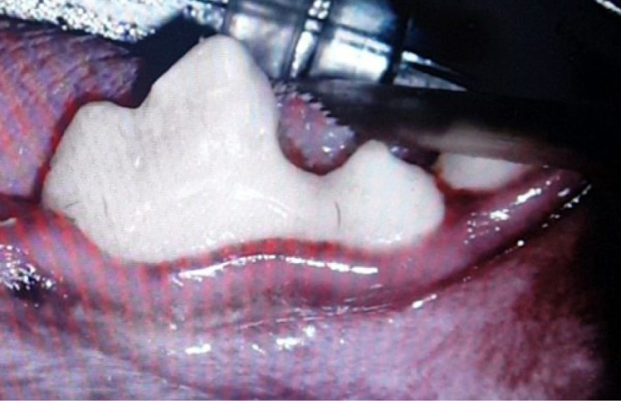 Close-up of a surgical extraction of a tooth, showing dental instrument and surrounding gum tissue.