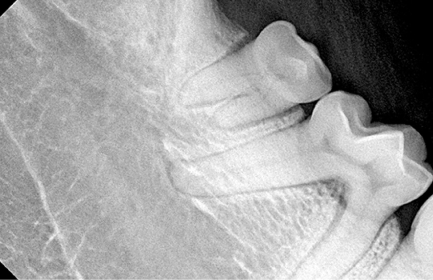 X-ray image of three molars, with one partially emerged and impacted, positioned at the back of the dental arch.