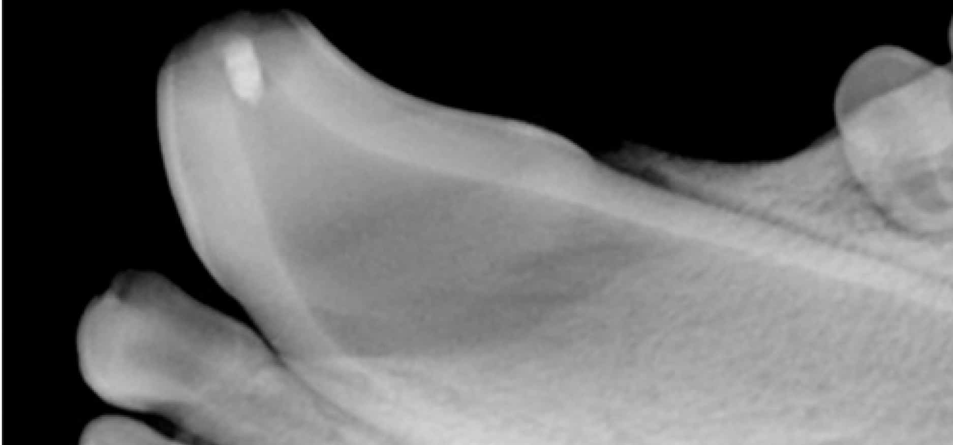 X-ray image of a foot, showing a side view with visible bones and a small, light-colored irregularity on the big toe.