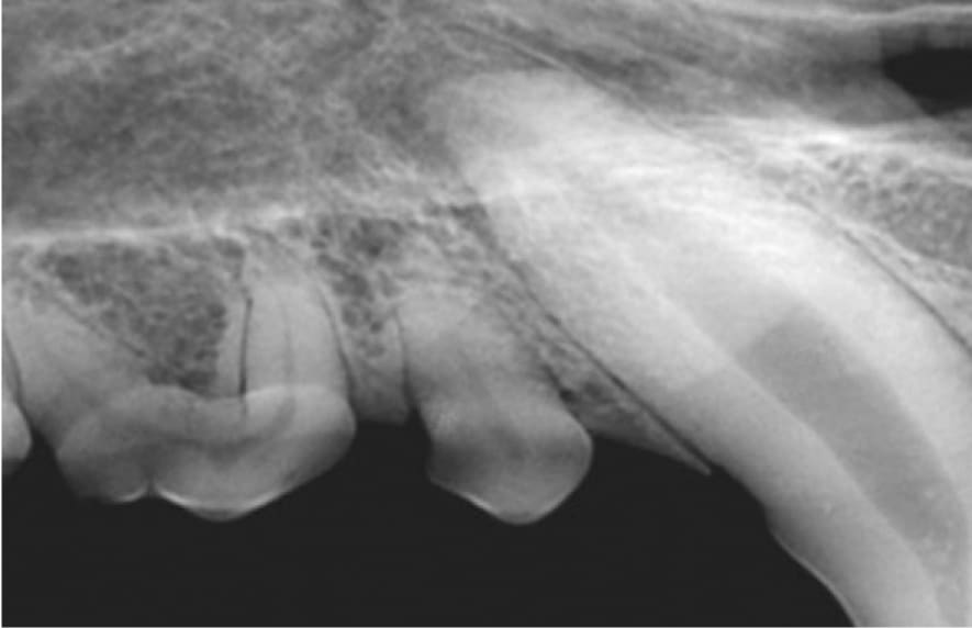 Dental X-ray showing a lateral view of several teeth, including a visible overlap and differing densities in the structures.