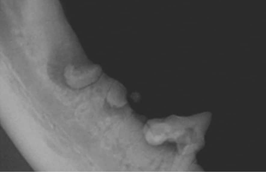 Dental X-ray showing impacted wisdom teeth along the jawbone.