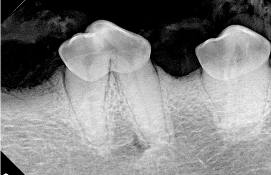 Dental X-ray showing two molars with visible roots and gum line.