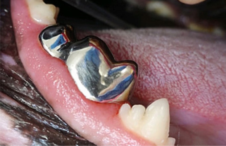 Close-up of a mouth showing a silver dental crown fitted on a molar, surrounded by natural teeth and gum tissue.