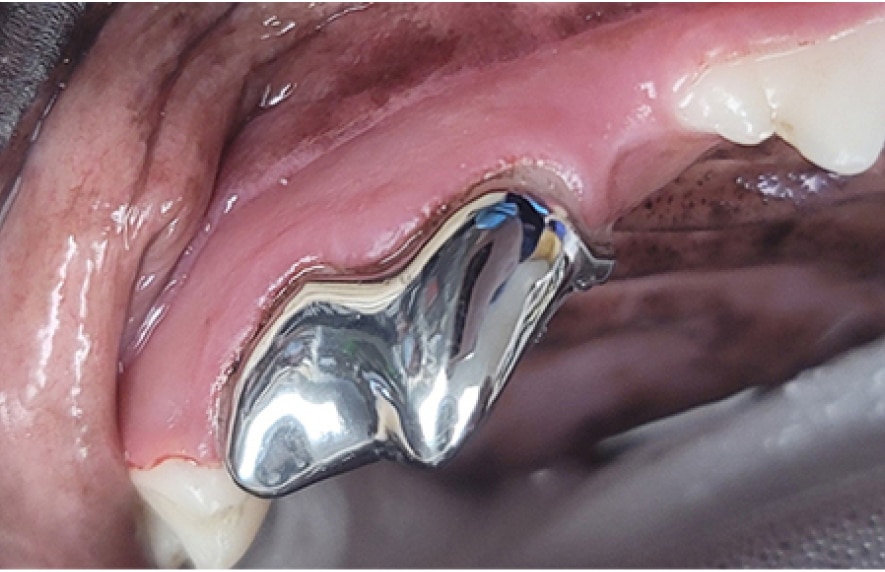 Close-up of a dental implant in the upper jaw, surrounded by gums, next to a natural tooth.