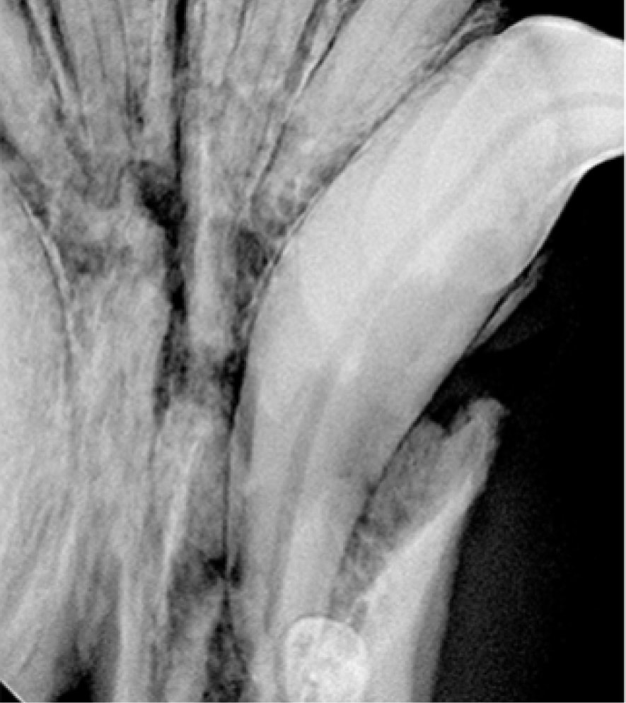 X-ray image of a shoulder joint showing bones and soft tissue.