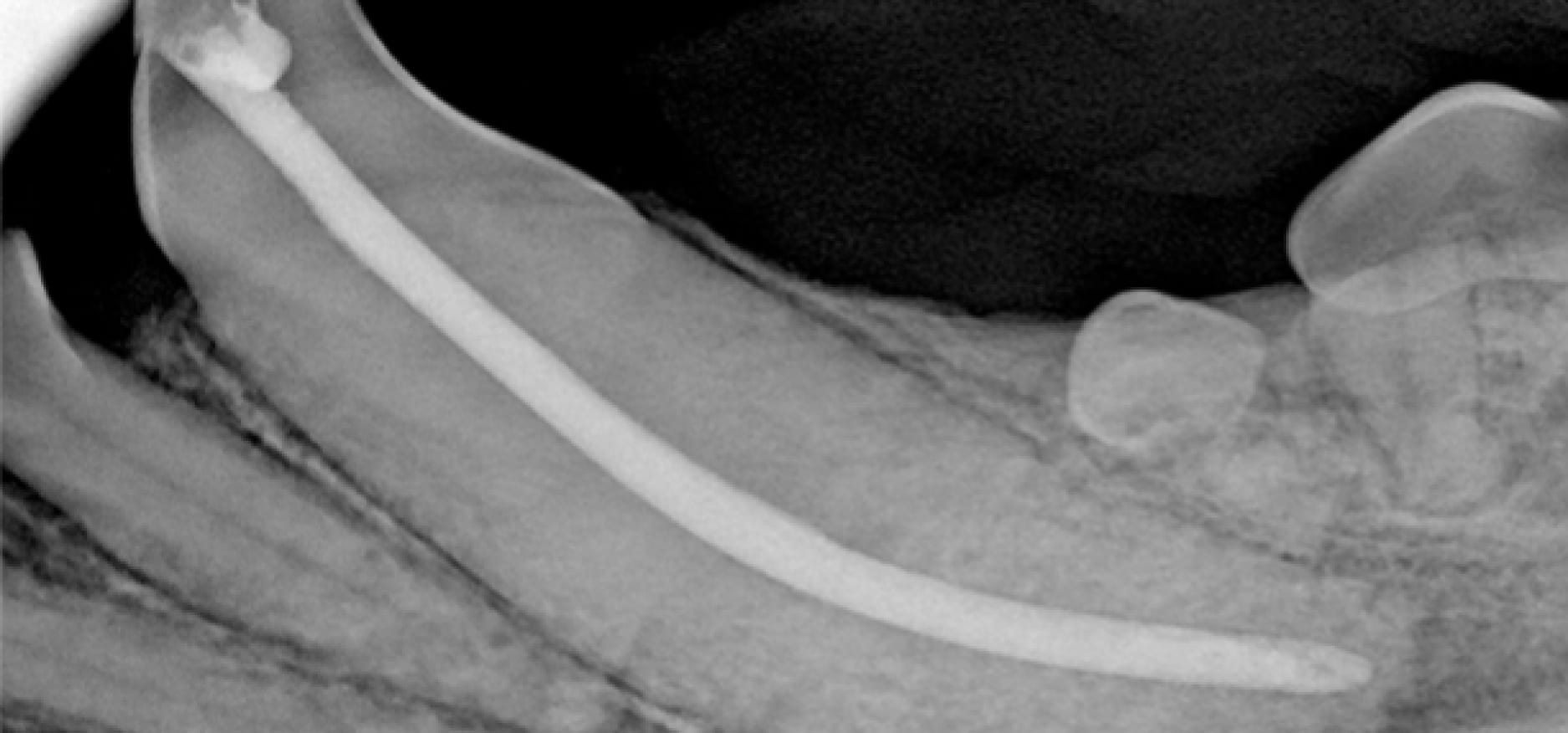 An X-ray of a person’s leg showing a long metal rod fixed along the length of the bone.