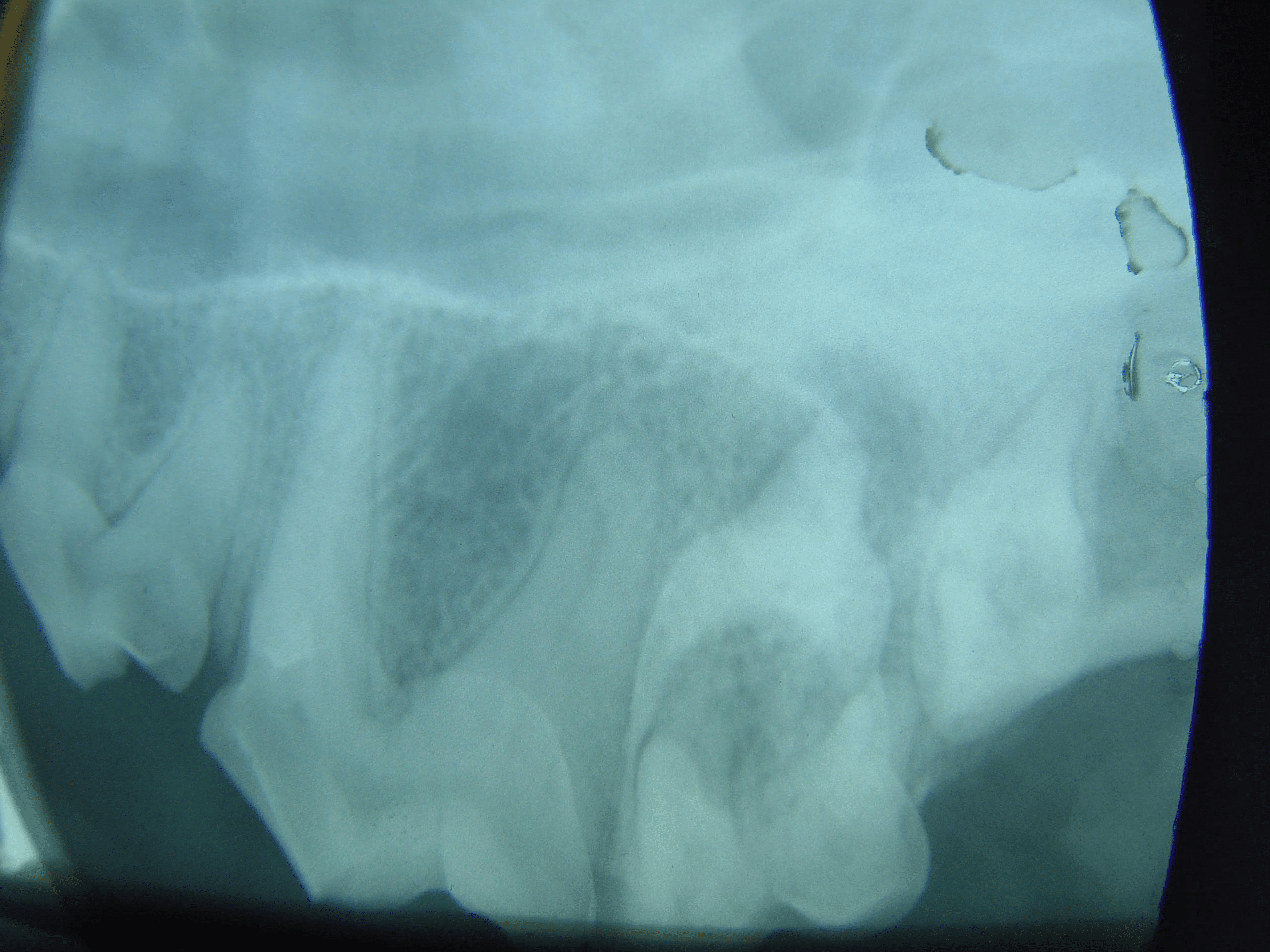 Dental X-ray showing teeth and jawbone structures.