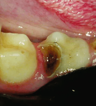 Close-up of a decayed tooth with significant cavity and decay, surrounded by gum tissue.