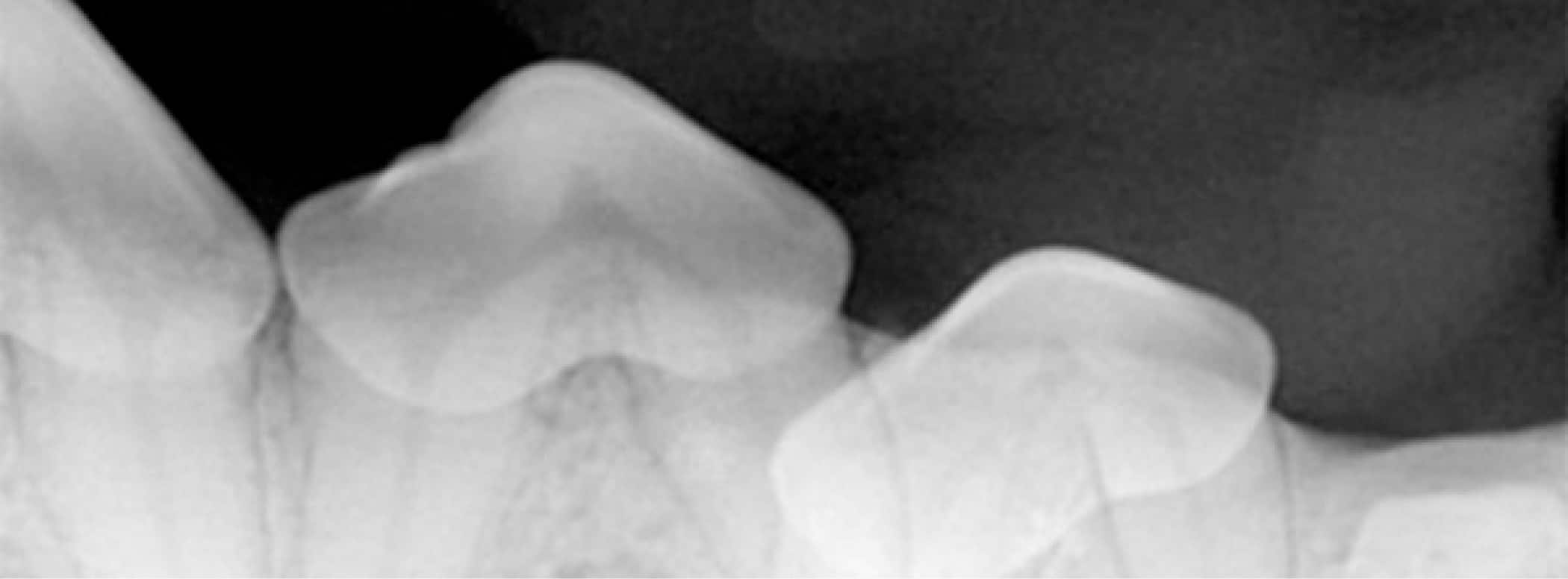 Dental X-ray showing a molar with a partially exposed wisdom tooth growing at an angle against it in the lower jaw.